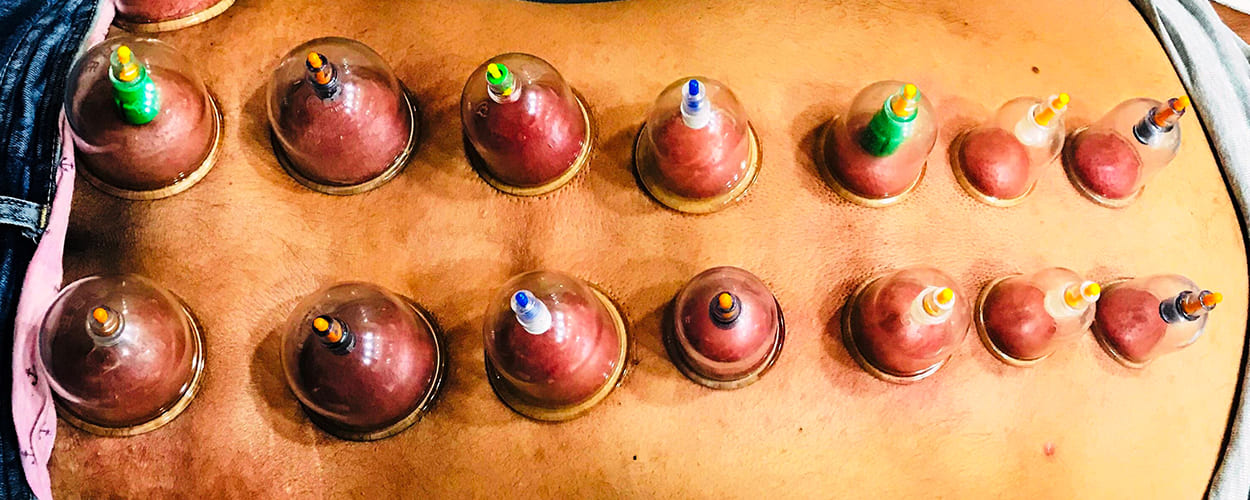 Cupping Therapy