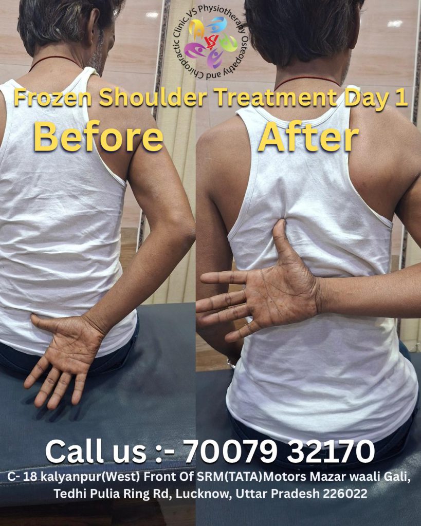 Frozen shoulder treatment before and after results at physiotherapy clinic in Lucknow