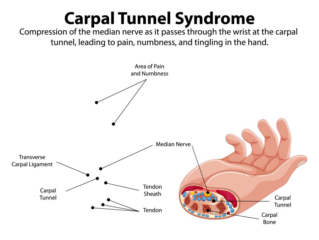 carpal tunnel syndrome diagram