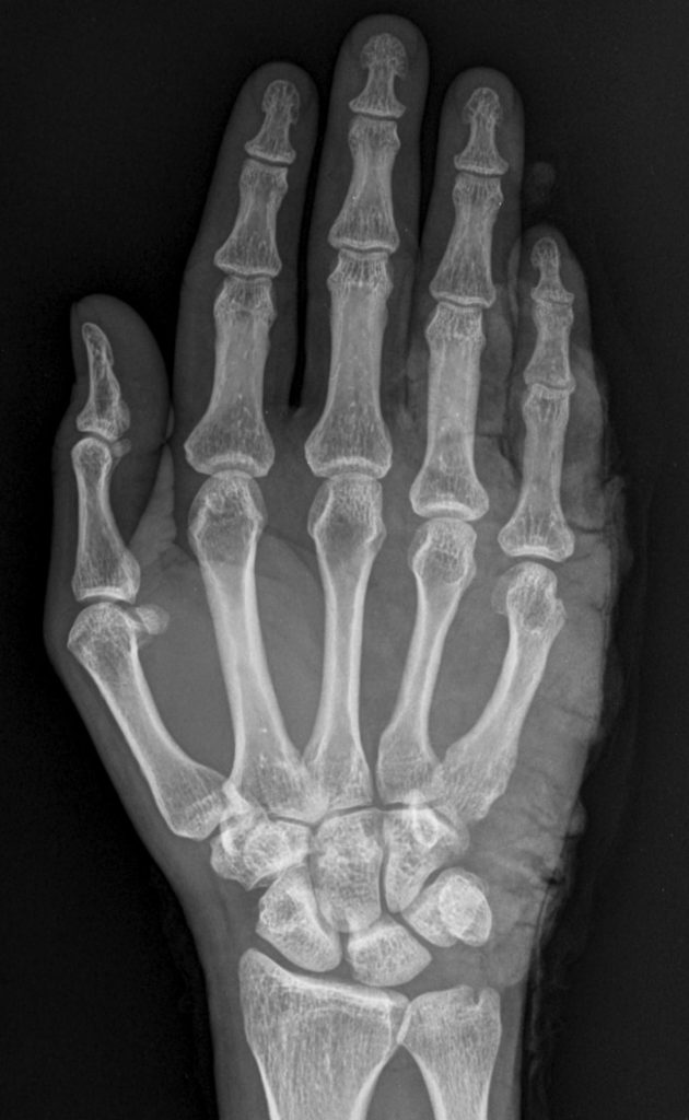 x-ray of human hand for carpal tunnel