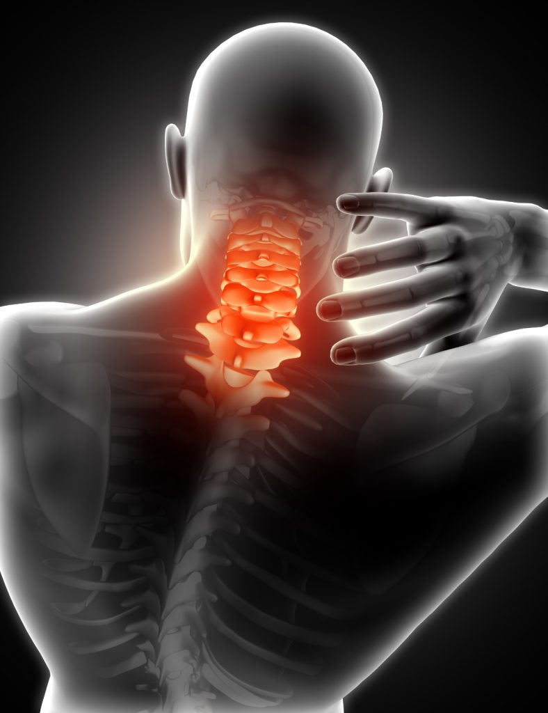 3D medical illustration showing cervical spine highlighted in red indicating pain and inflammation in a person holding their neck