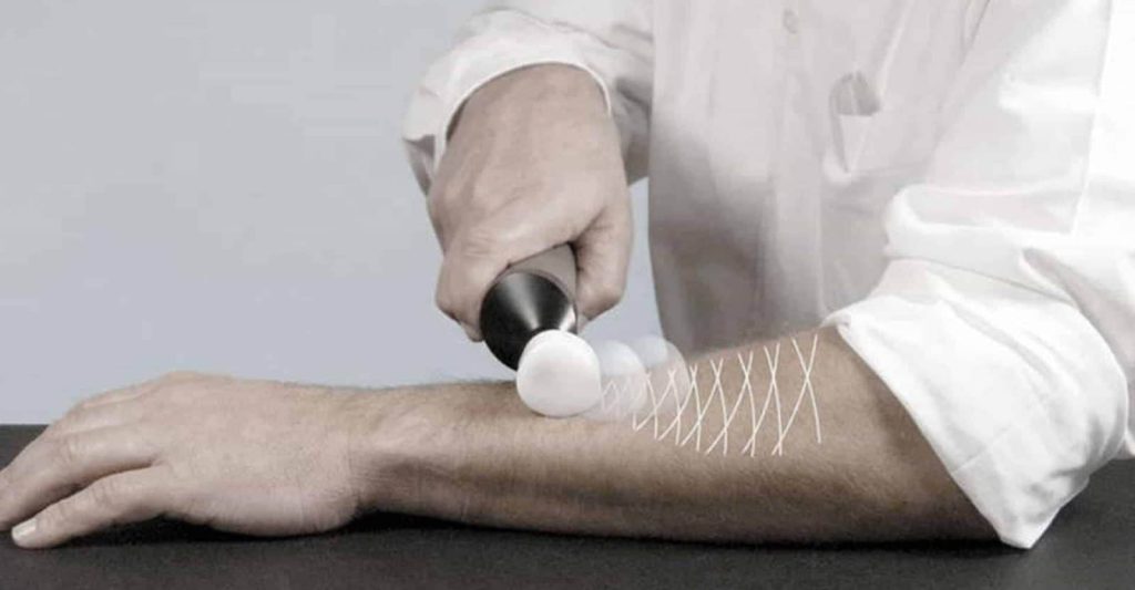 Matrix Rhythm Therapy treatment being applied on patient's forearm at VS Physiotherapy Clinic Lucknow