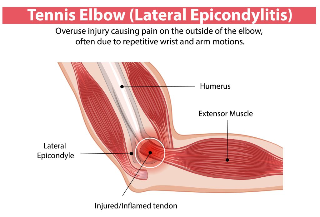 tennis elbow treatment in lucknow