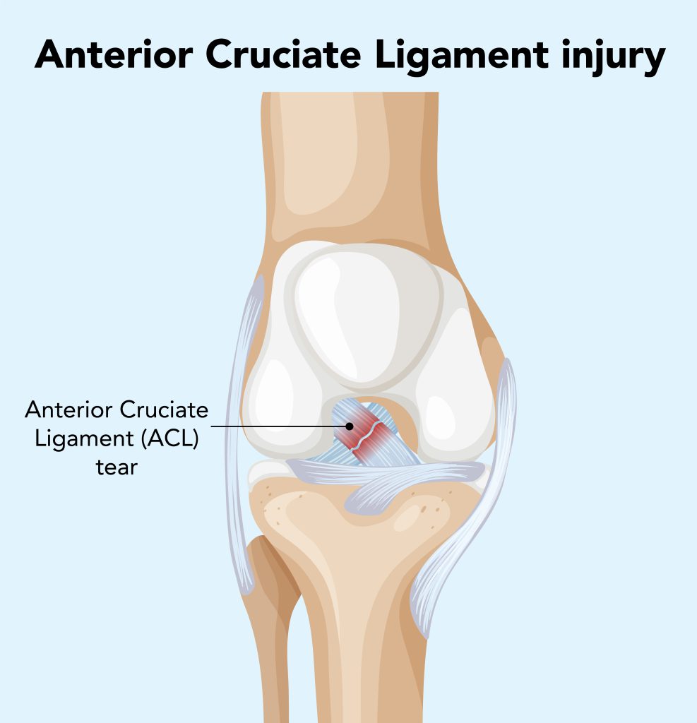 Anatomical diagram of an anterior cruciate ligament (ACL) tear inside the knee joint