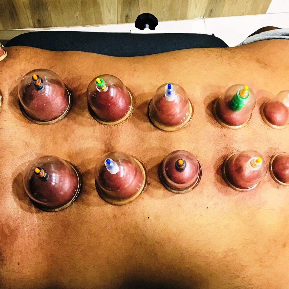 cupping2a